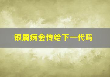 银屑病会传给下一代吗